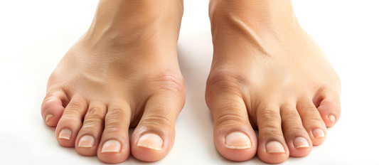 Understanding Bunions: Causes, Symptoms, and Treatments