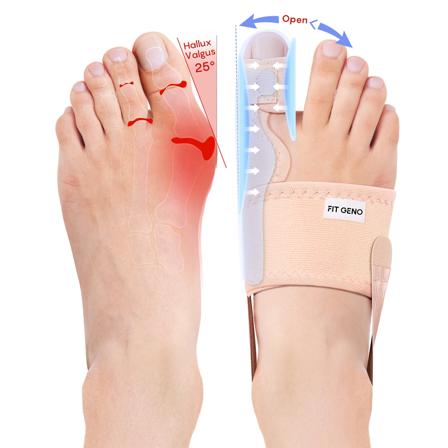 Bunion Corrector